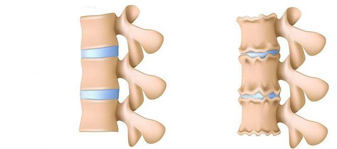 Osteochondroza regiunii lombare