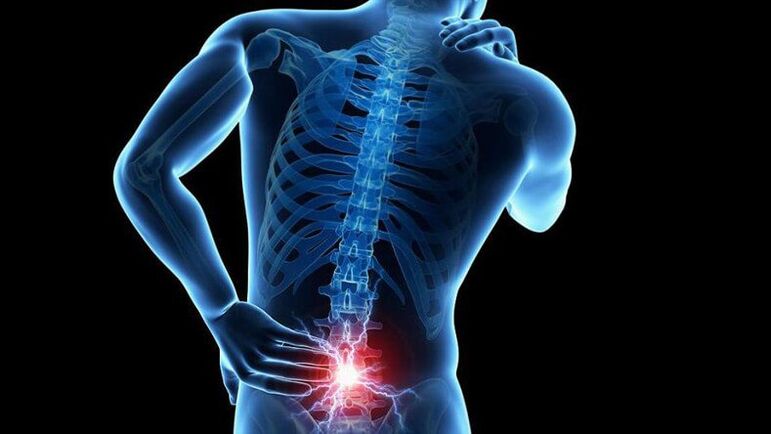 Simptomele osteochondrozei lombare